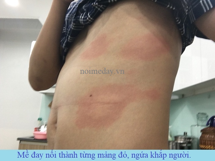 Bệnh mề đay dị ứng